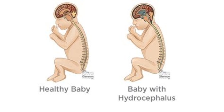 Can a baby survive fetal hydrops?
