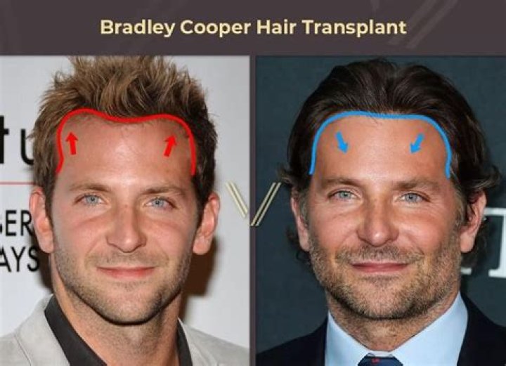 
Did Bradley Cooper Get Plastic Surgery? Who is Bradley Cooper? 