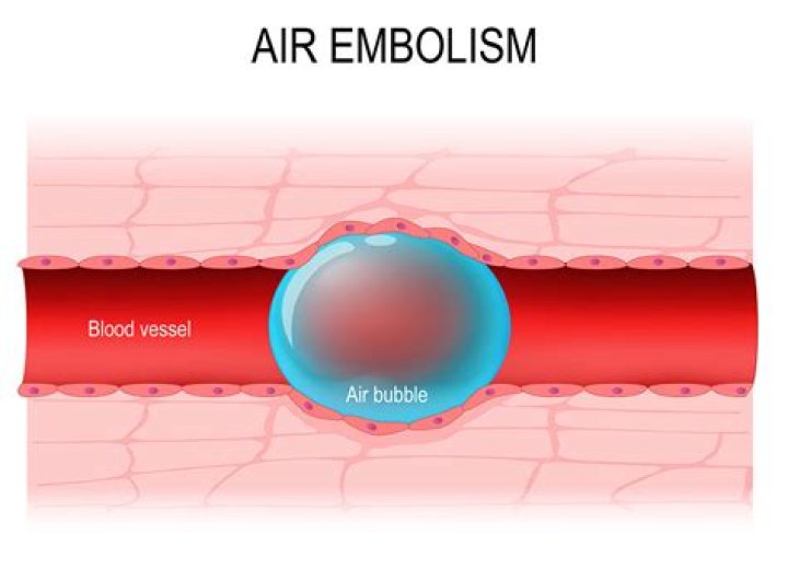 How much air in IV line is dangerous?