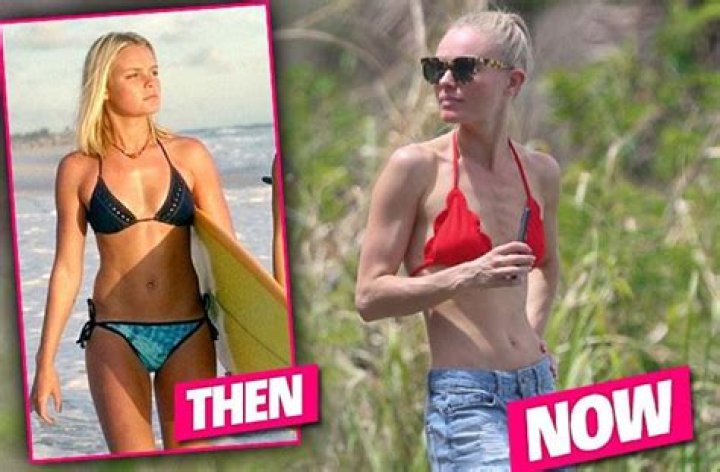 Is Kate Bosworth showing off her bones and her sunburn?