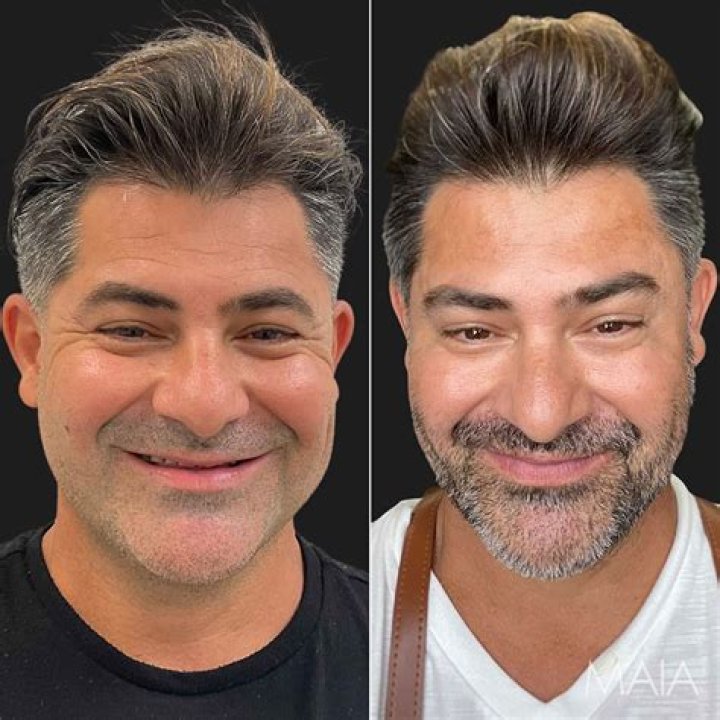 Joel McHale Plastic Surgery – Did He Get A Botox? Before And After Photos