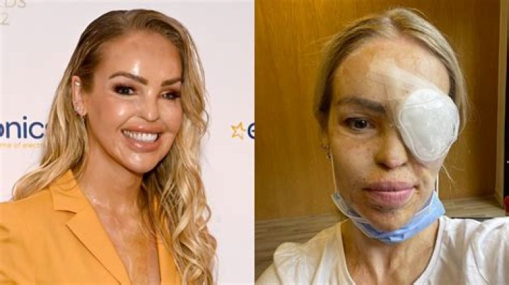 Katie Piper is down with a bad infection and also has some eye irregularities!