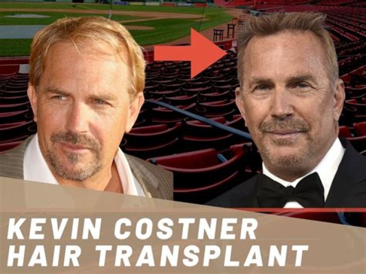 Kevin Costner’s advancing hairline