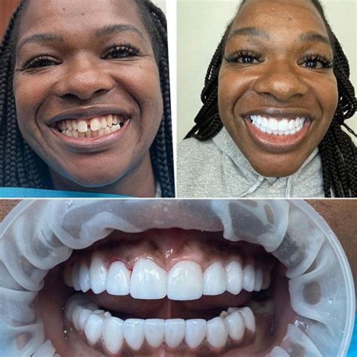 Linnocent claims her new veneers are just her old meth teeth, whitened
