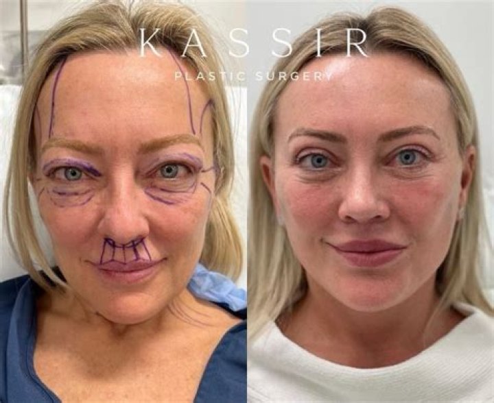 Lisa Riley | Plastic Surgery Before And After Photos