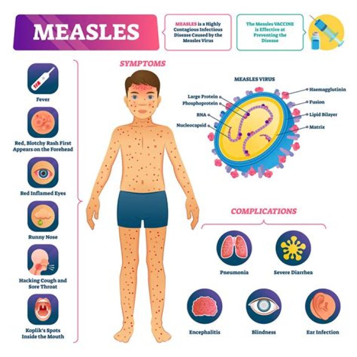 Measles is back and is ‘much more serious than the chickenpox’