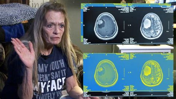 Was Carolyn Warmus Face Paralyzed? What Happened? Brain Tumor And Illness