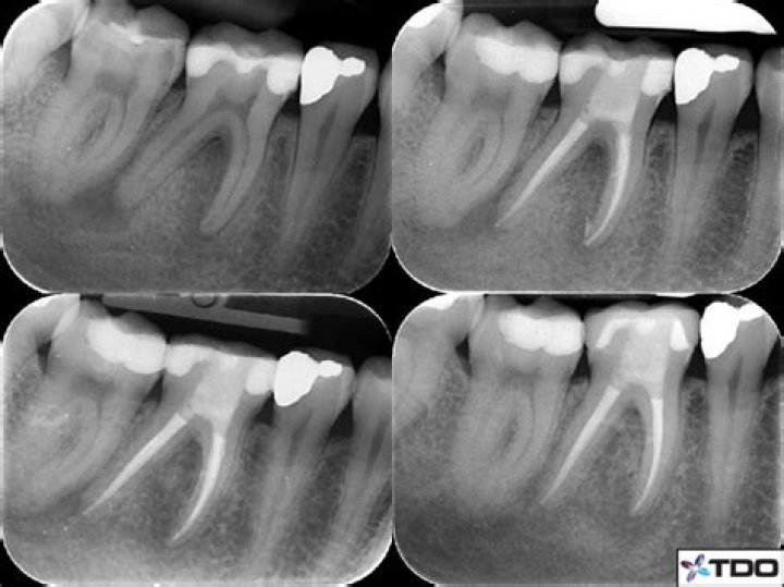 What does Parl stand for in dentistry?