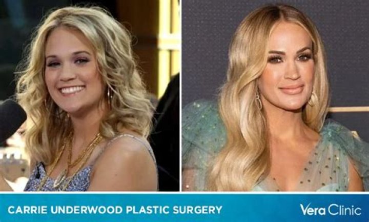 What Happened to Carrie Underwood’s Face? Who is Carrie Underwood? Carrie Underwood’s Age, Net Worth, and More
