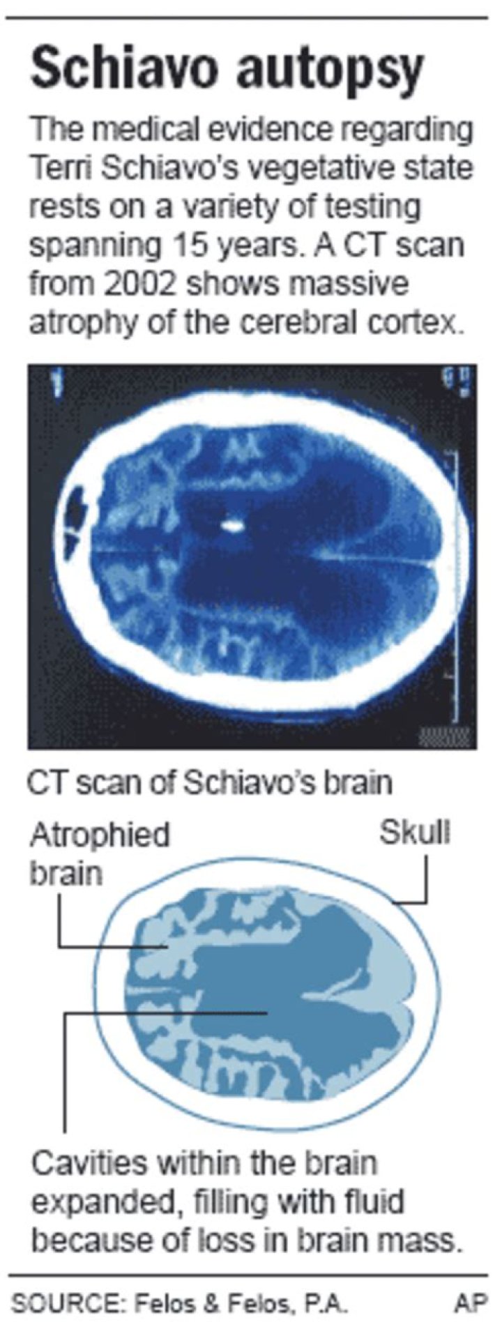 What Happened To Terri Schiavo Brain? Autopsy Reveal And Documentary Details