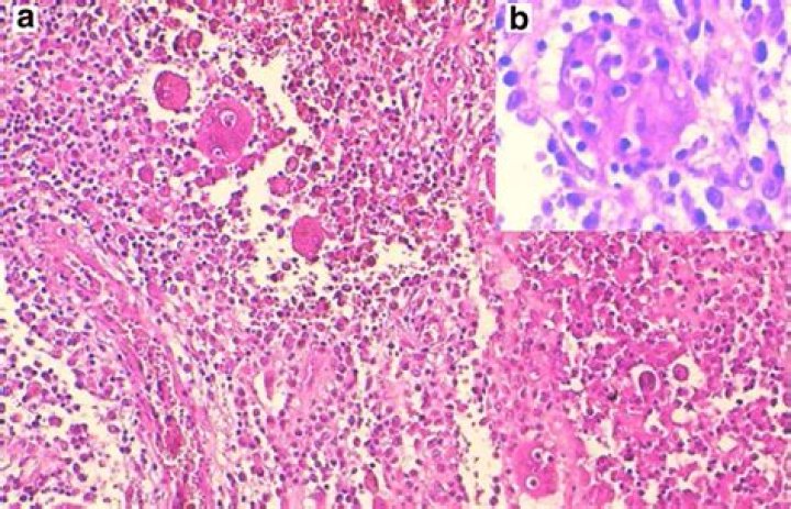 What is a Lymphohistiocytic infiltrate?