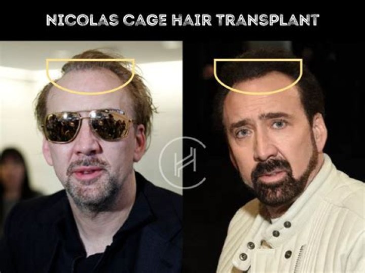 What is going on with Nicolas Cage’s hair (plugs)?