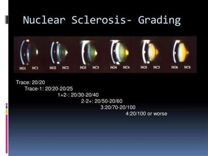 What is nuclear sclerosis of the eyes?