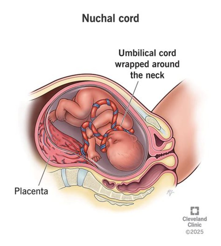 What is the meaning of nuchal rigidity?